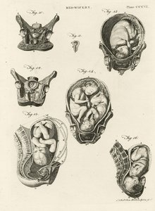 助産術、「百科事典ブリタニカ」のイラスト、エジンバラ、1798年に発行（銅版画）